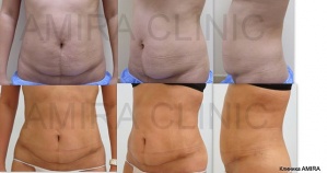 Липосакция фото 24