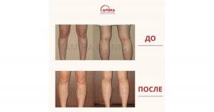 Круропластика фото 0