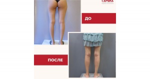 Круропластика фото 1