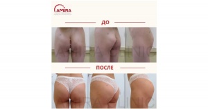Глютеопластика фото 0
